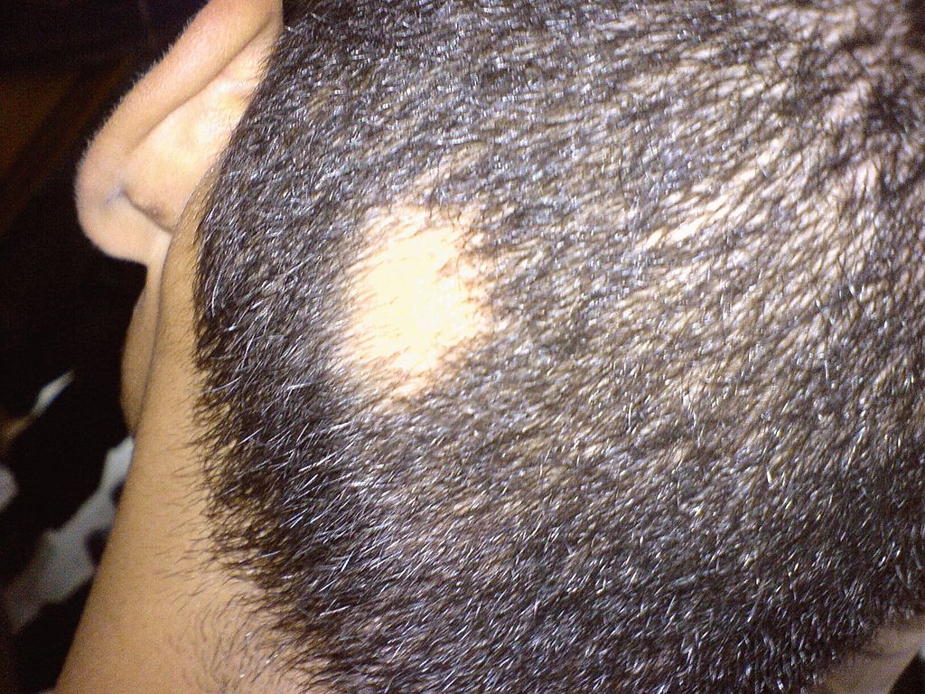 Alopeci